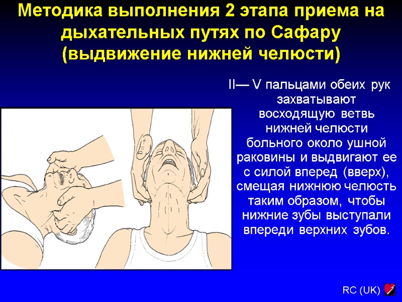 Методика выполнения 2 этапа приема на дыхательных путях по Сафару (выдвижение нижней челюсти) 0